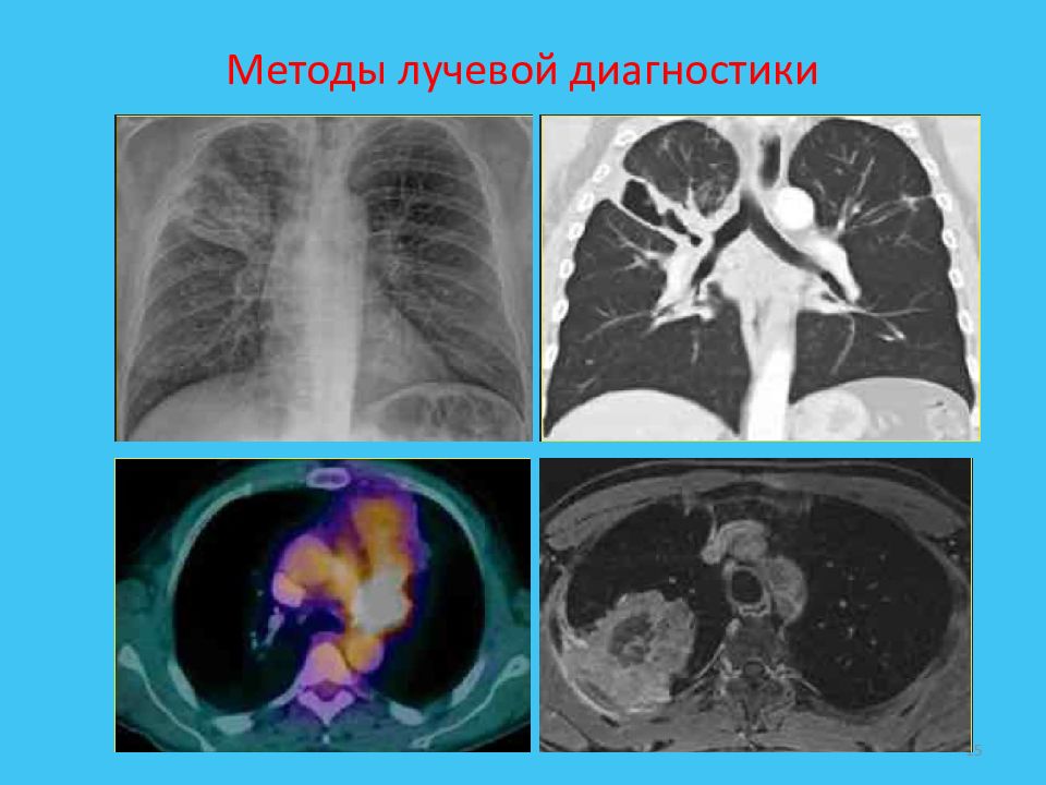 Лучевая диагностика рака легкого презентация