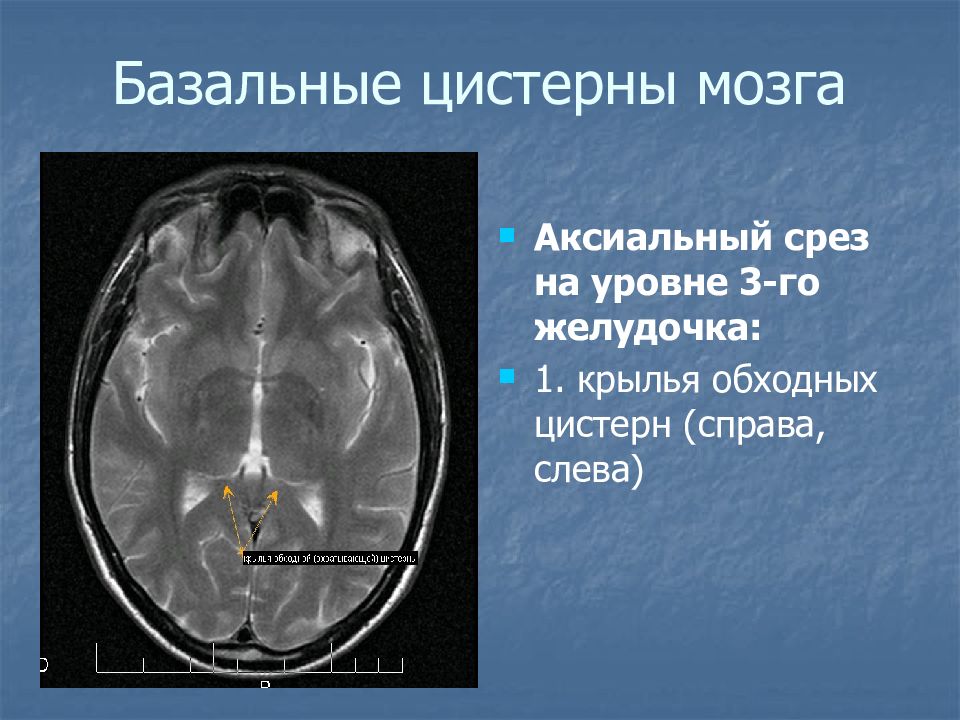 Цистерны мозга расширены. Цистерна Меккеля головной мозг. Мостомозжечковая цистерна анатомия. Мостомозжечковая цистерна мрт. Базальные цистерны головного мозга кт анатомия.