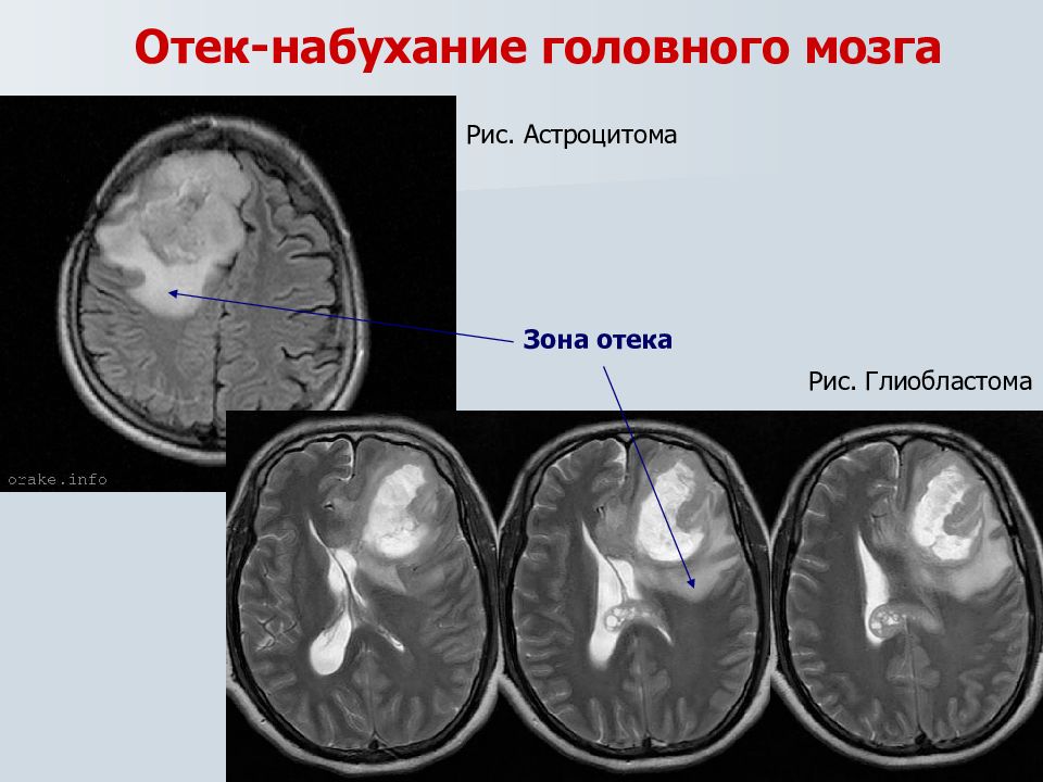 Клиническая картина отек мозга