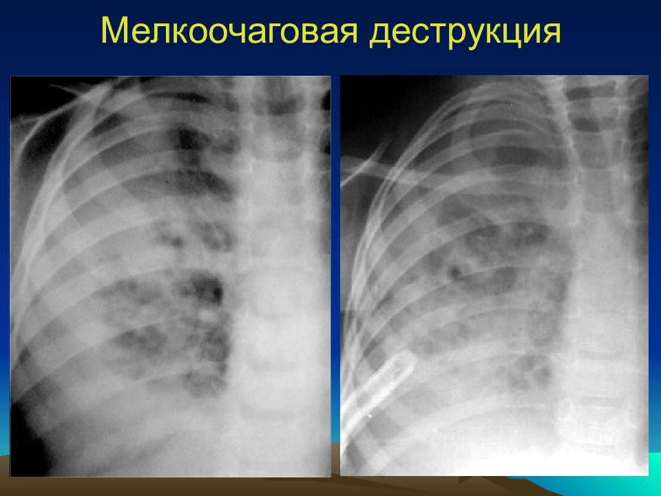 Острая гнойная деструктивная пневмония у детей презентация