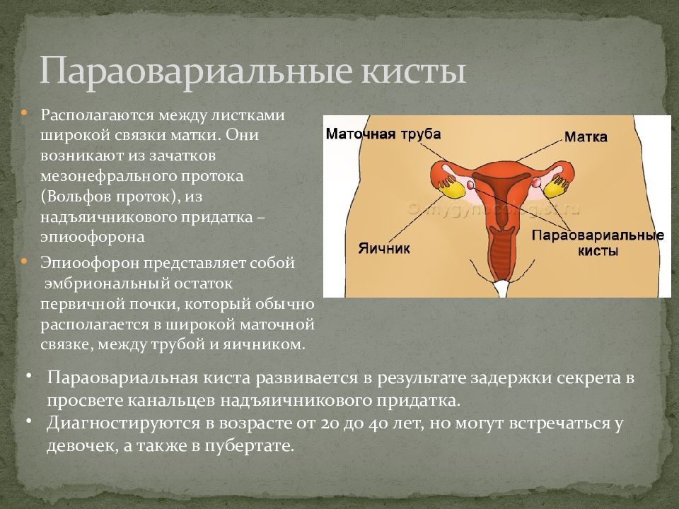 Перекрут придатков матки презентация