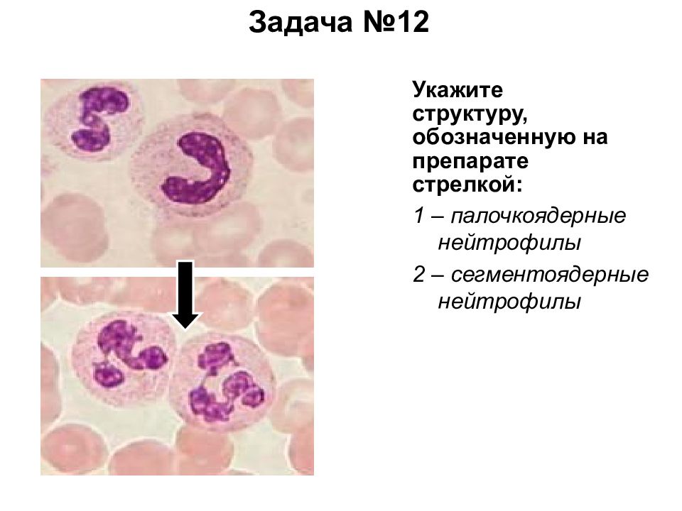 Палочкоядерные 2. Палочкоядерные нейтрофилы строение. Строение нейтрофилов крови. Палочкоядерные нейтрофилы препарат. Сегментоядерный нейтрофильный гранулоцит.