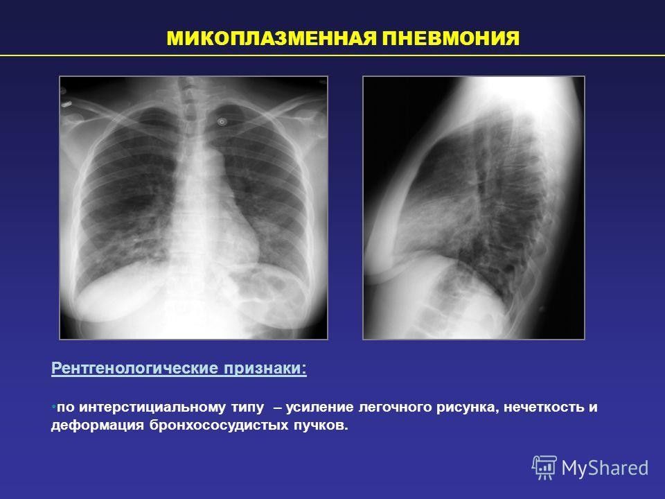 Атипичная пневмония картинки