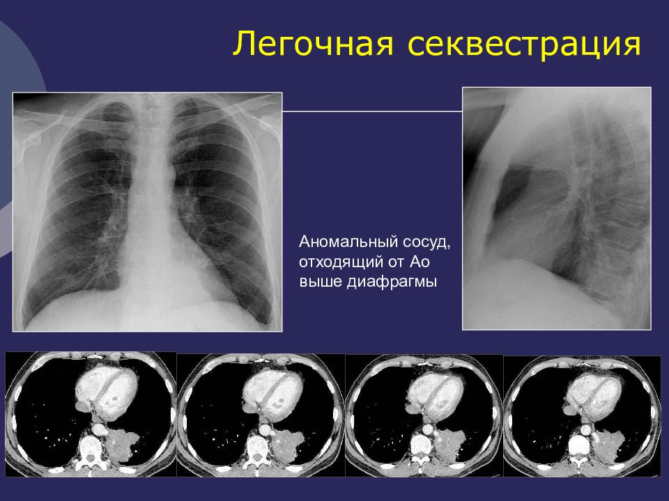 Кисты легких у детей презентация