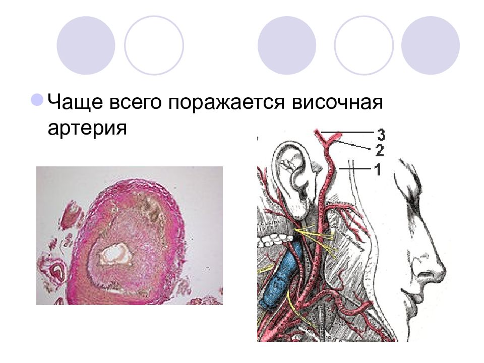 Болезнь хортона презентация