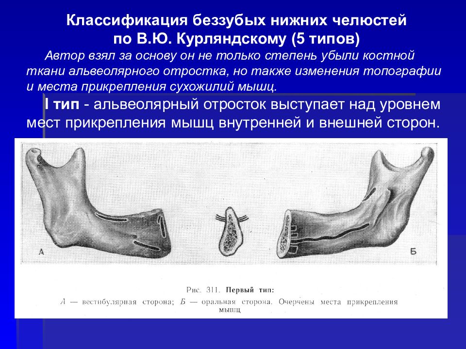 Классификация челюстей по шредеру. Классификация Оксману беззубых челюстей. Классификация Курляндского беззубых челюстей. Классификация Шредера беззубых челюстей. Курляндский ортопедическая стоматология классификация.