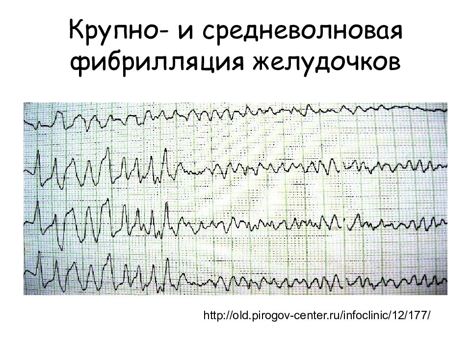 Аритмии презентация факультетская терапия