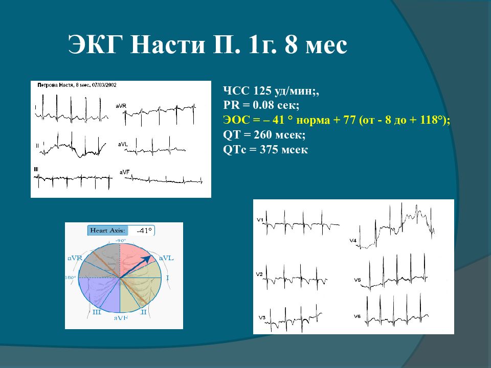 Мм экг. ЭКГ ЭОС 41градус. Показатели ЭОС на ЭКГ. Нормы ЭКГ В мсек. ЧСС на ЭКГ норма.