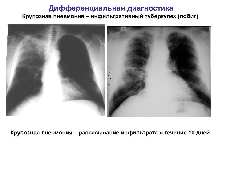 Дифференциальная диагностика при легочном инфильтрате презентация