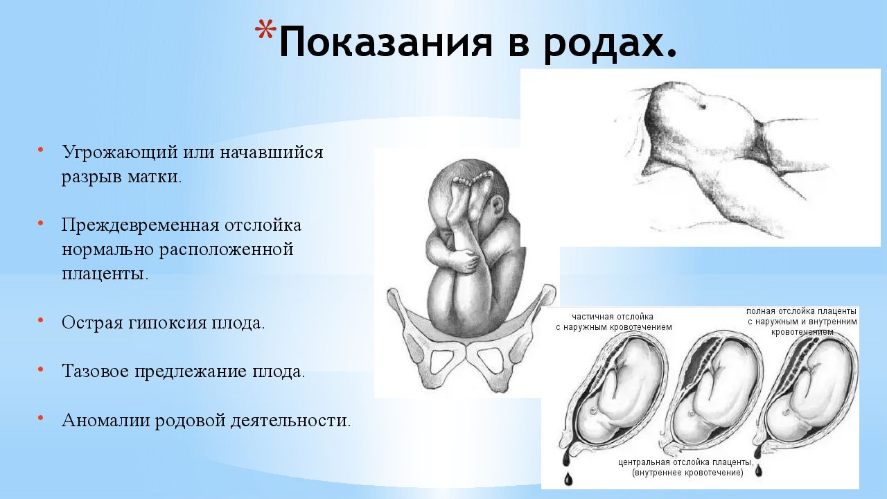 Кесарево сечение у коров презентация