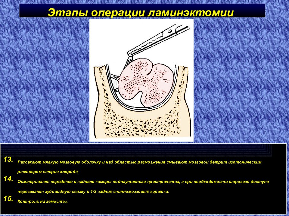 Этапы операции. Операции на позвоночнике и спинном мозге. Операция этапы операции. Операция ламинэктомия.
