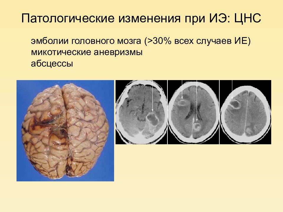 Инфекционный эндокардит презентация