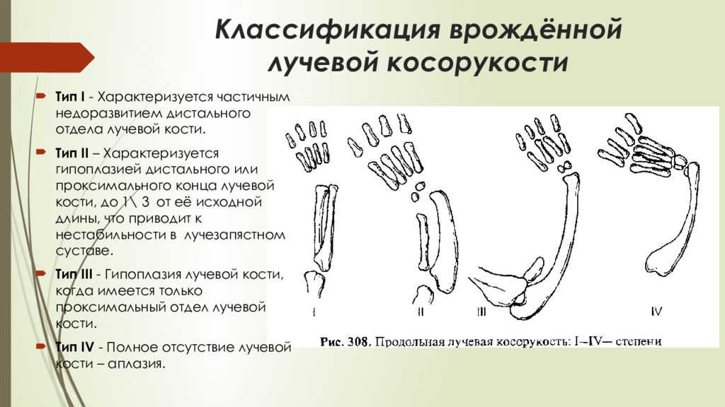 Аномалии развития верхних конечностей презентация