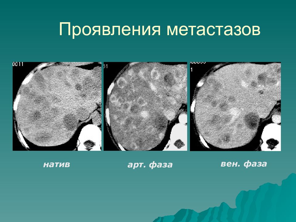 Очаговое поражение. Гепатоцеллюлярная аденома печени УЗИ. Гепатоцеллюлярная аденома мрт. Первичный склерозирующий холангит кт.