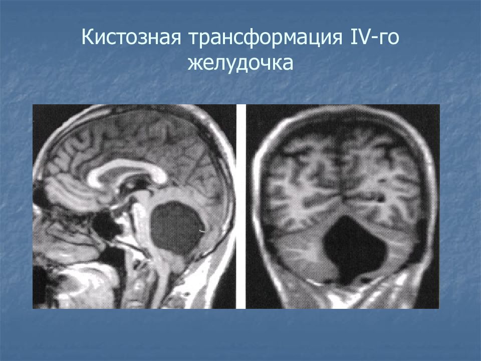Кистозно атрофические изменения головного. Кистозная трансформация головного мозга кт. Кистозная трансформация 4 желудочка. Кистозная лейкомаляция головного мозга. Кистозная трансформация желудочков головного мозга.