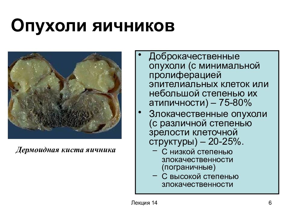 Опухоль яичников причина