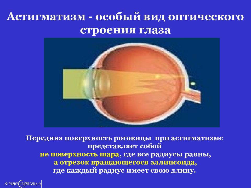 Сложный гиперметропический астигматизм глаз
