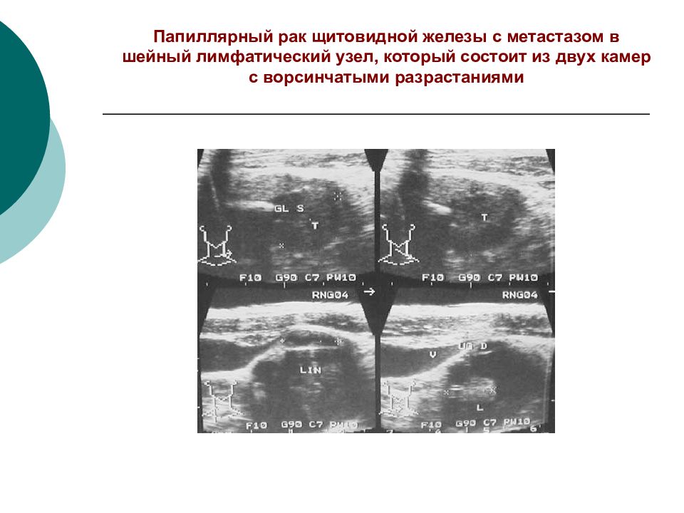 Злокачественные опухоли щитовидной железы презентация