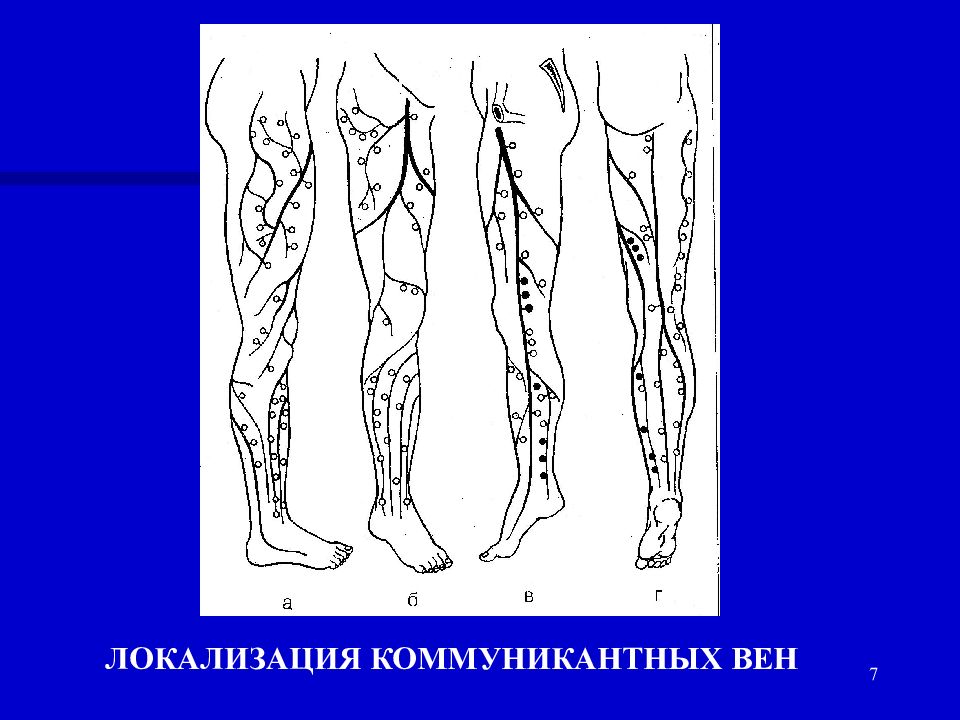 Перфорантных вен. Коммуникантные вены нижних конечностей. Коммуникантные вены голени. Коммуникантные и перфорантные вены.