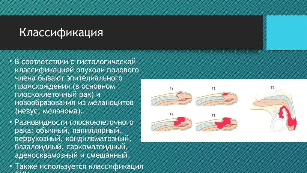 Типы членов. Классификация членов. Опухоль полового органа. Классификация полового члена. Новообразования полового члена.