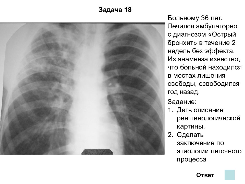 Рентген картина бронхита что это