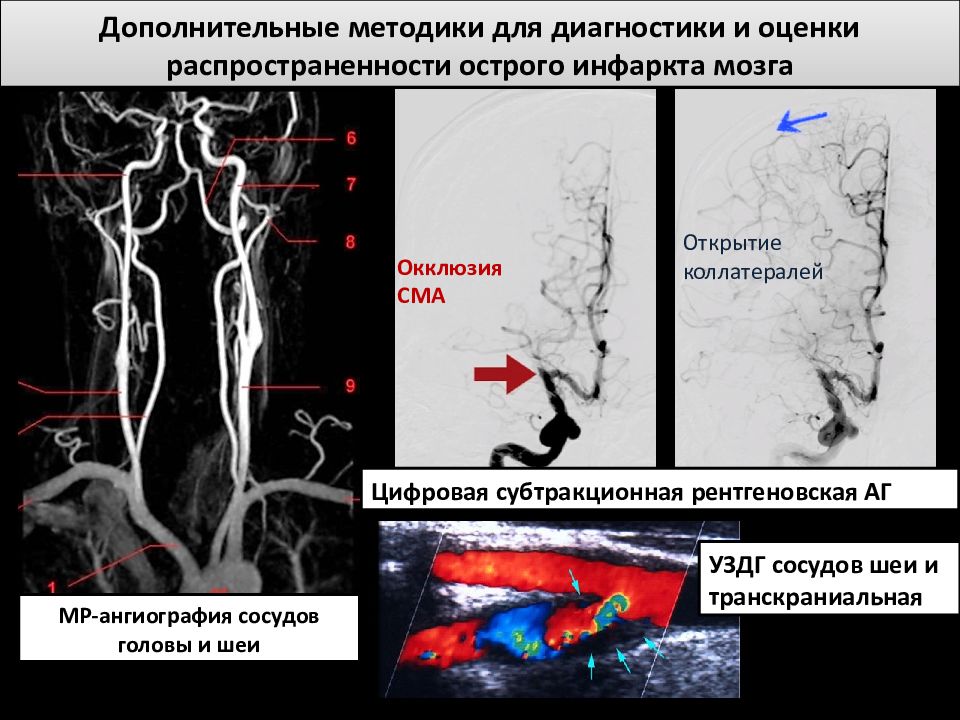 Тромбоз артерий мозга. Окклюзия средней мозговой артерии. Окклюзия магистральных артерий. Инфаркт средней мозговой артерии. Окклюзия базилярной артерии.