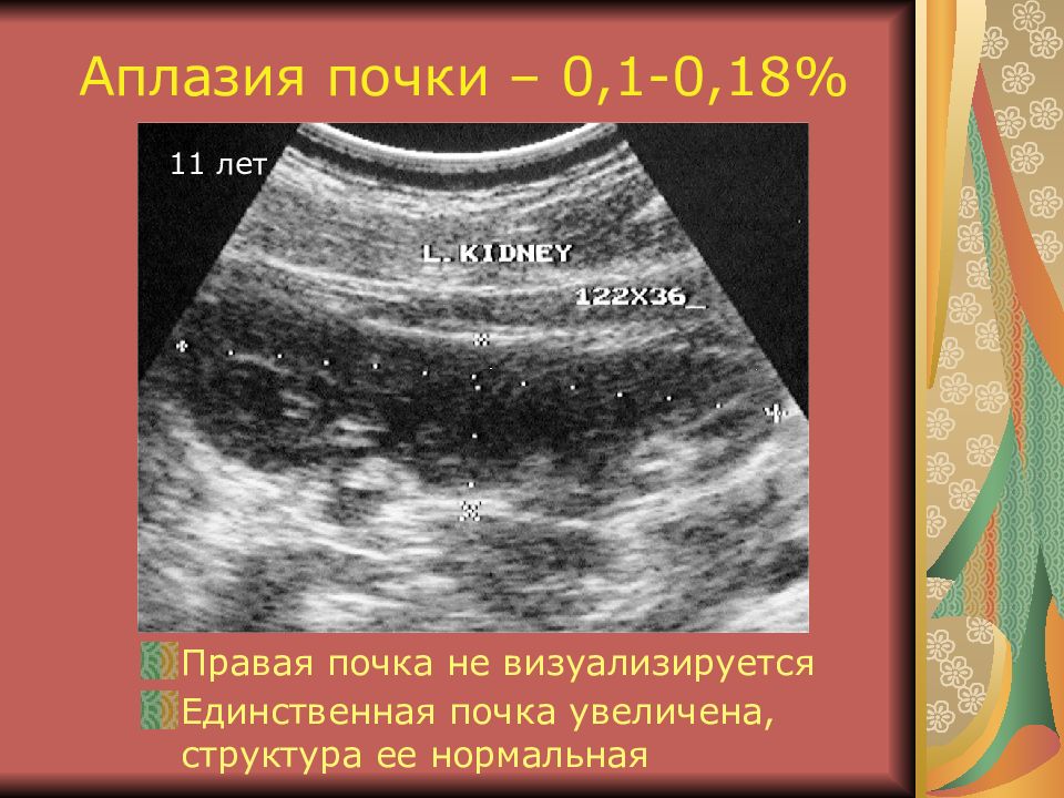 Визуализируется. Аплазия правой почки на УЗИ. Единственная почка УЗИ.