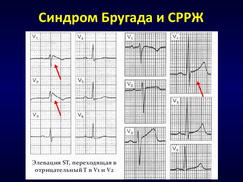 Синдром реполяризации желудочков у ребенка. Синдром Бругада на ЭКГ. Синдром Бругада ЭКГ критерии. Синдром ранней реполяризации желудочков. Синдром Бругада на ЭКГ фото.