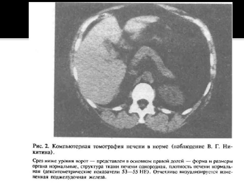 Кт Печени Фото