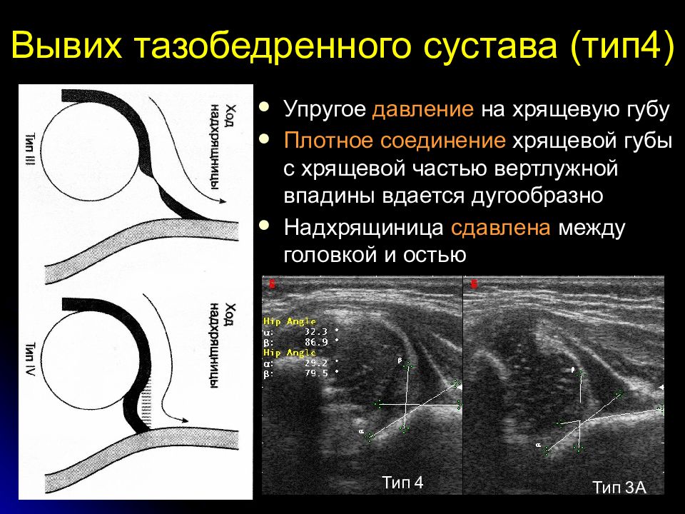 Что покажет узи тазобедренного сустава. Нормальные показатели УЗИ тазобедренных суставов у детей. УЗИ анатомия тазобедренного сустава у детей. УЗИ дисплазия тазобедренного сустава показатели. Классификация дисплазии тазобедренных суставов по графу.