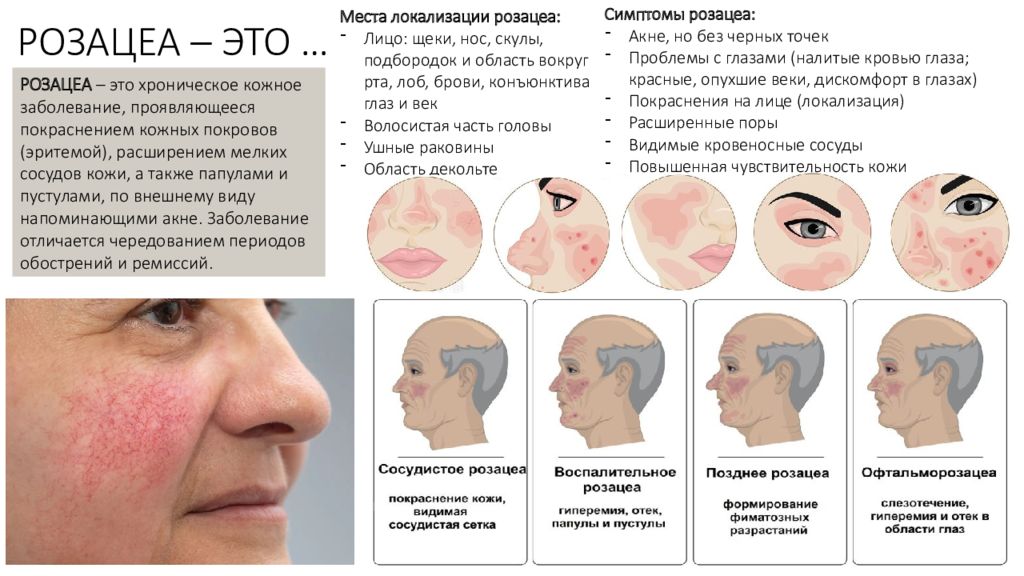 Розацеа анализы сдать