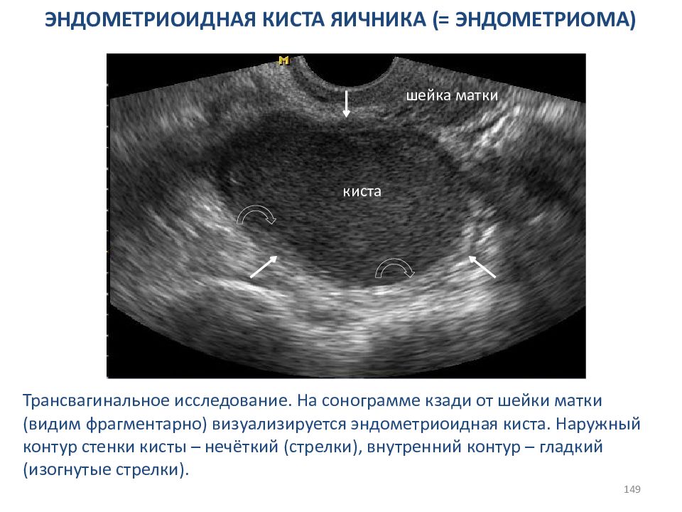 Опасна ли эндометрия матки. Эндометриомы яичников. Эндометриоидная киста шейки матки на УЗИ. УЗИ заключение эндометриоидная киста правого яичника. Киста яичника эндометриома.