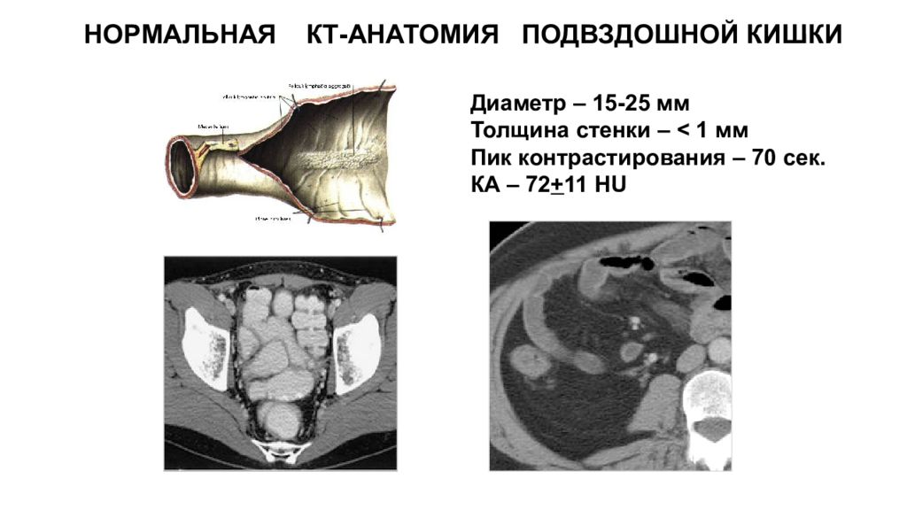 Толщина стенки кишки