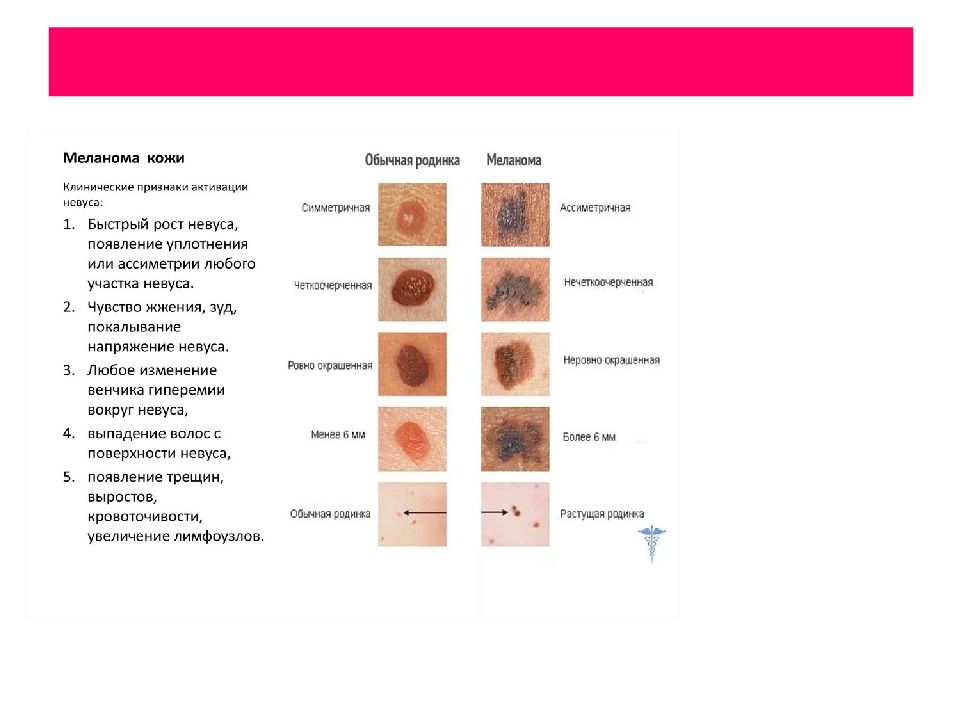 Дифференциальная диагностика меланомы. Новообразования кожи классификация. Меланома кожи классификация. Новообразования кожи на лице классификация. Опухоли кожи презентация.