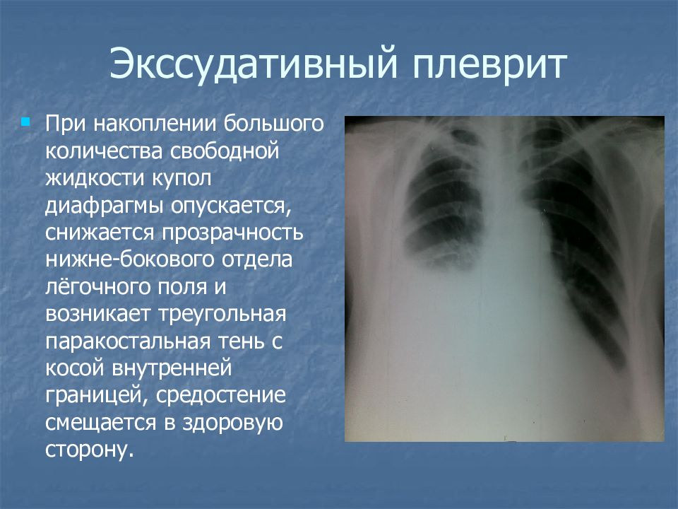 Плевра на рентгене. Осумкованный паракостальный плеврит. Экссудативный плеврит рентген. Паракостальный плеврит рентген.