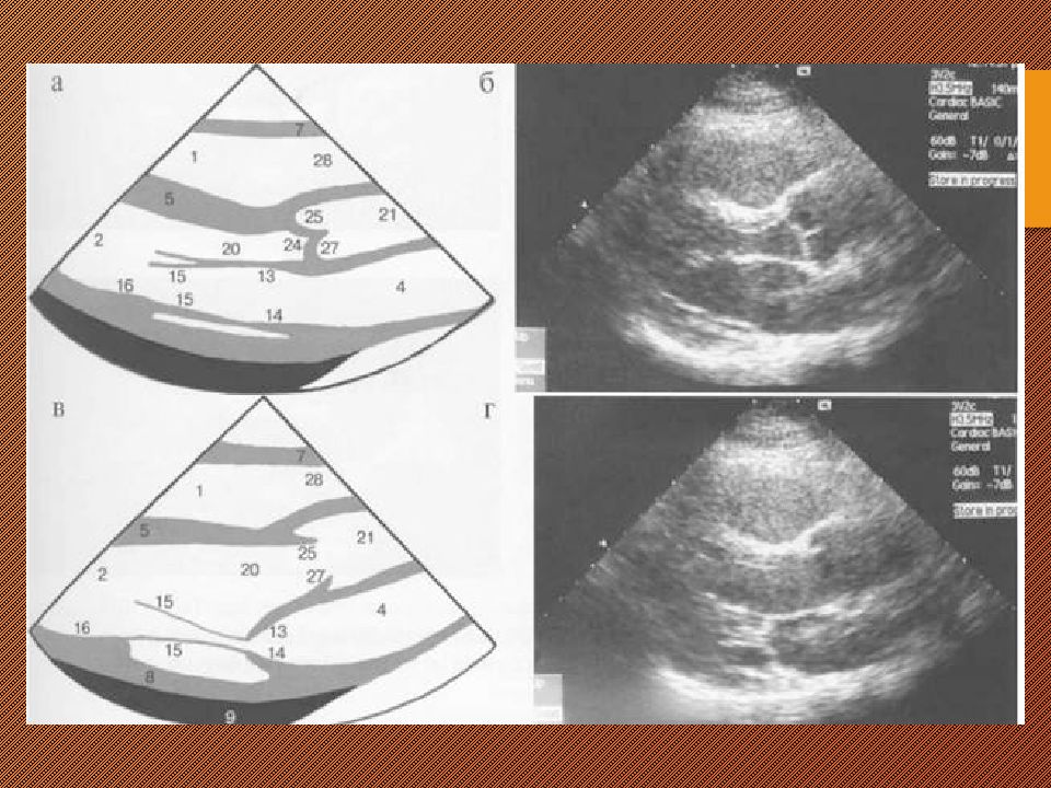 Сегменты сердца на узи схема