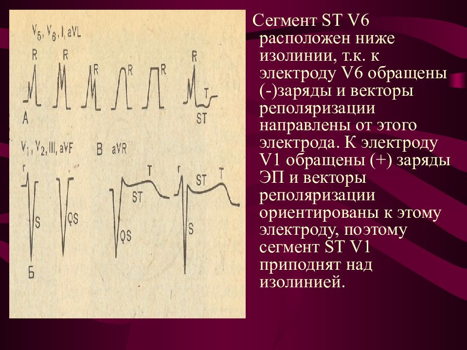 Ниже т. Вектор реполяризации. Т ниже изолинии. SТ- сегмент. Сегмент ст ниже изолинии.