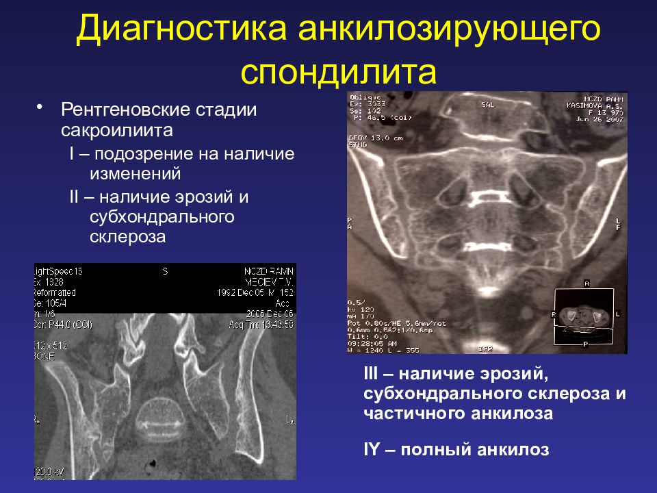 Анкилозирующий спондилит презентация