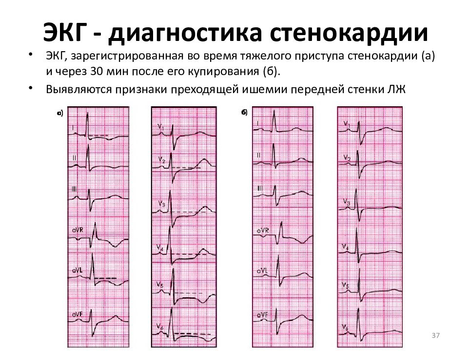 Ишемия нижней стенки на экг