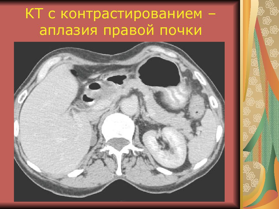 Кт картина са левой почки