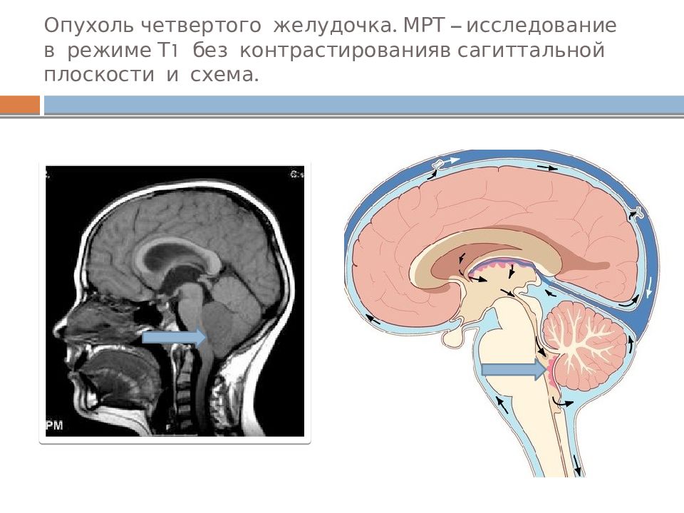 Рак головного мозга презентация