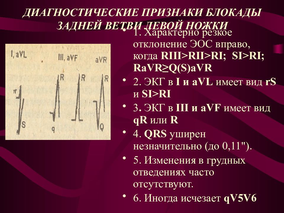 Признаки блокада левой ножки. Блокада задней ветви ЛНПГ на ЭКГ. Блокада задней ветви левой ножки пучка Гиса на ЭКГ. Блокада задней ветви левой ножки на ЭКГ. Блокада левой задней.