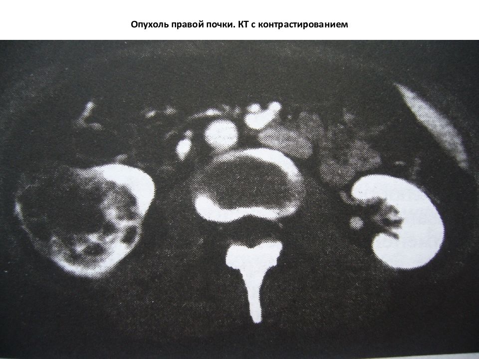 Объемное образование правого. Опухоль правой почки на кт. Аденома почки на кт с контрастированием. Контрастирование опухолей почек.