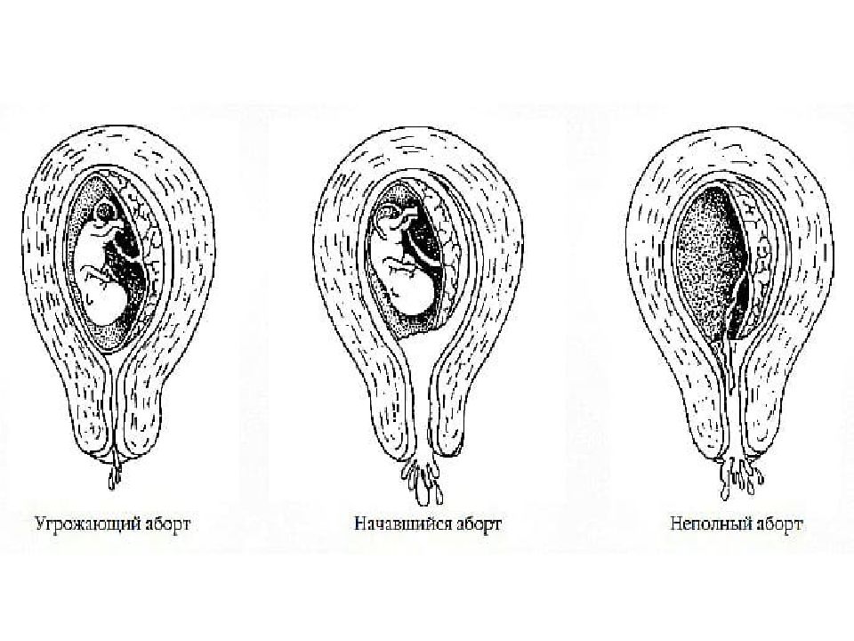 Сохранение при угрозе выкидыша. Гестозы, невынашивание, рисунок. Транспортировка при угрозе выкидыша. Выкидыш беременной селедки Мем. Если у женщины 2 выкидыша и 3 родов это привычное невынашивание.