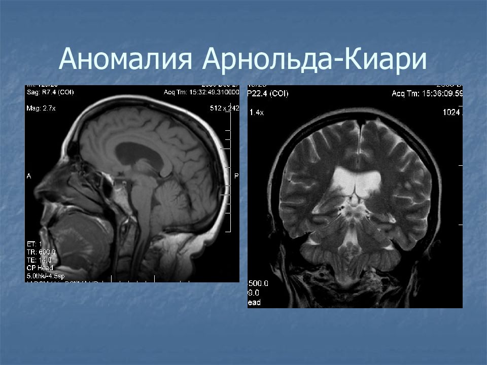 Картина мальформации арнольда киари 1