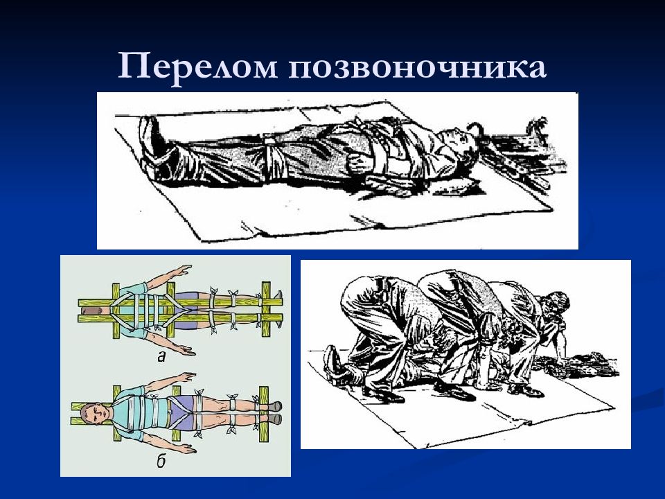 Переломы позвоночника презентация