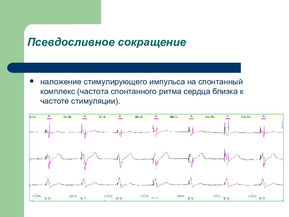 Сливной экс. Сливные комплексы на ЭКГ. Сливные желудочковые комплексы на ЭКГ. Сливные и псевдосливные комплексы на ЭКГ. Сливные комплексы на ЭКГ при экс.