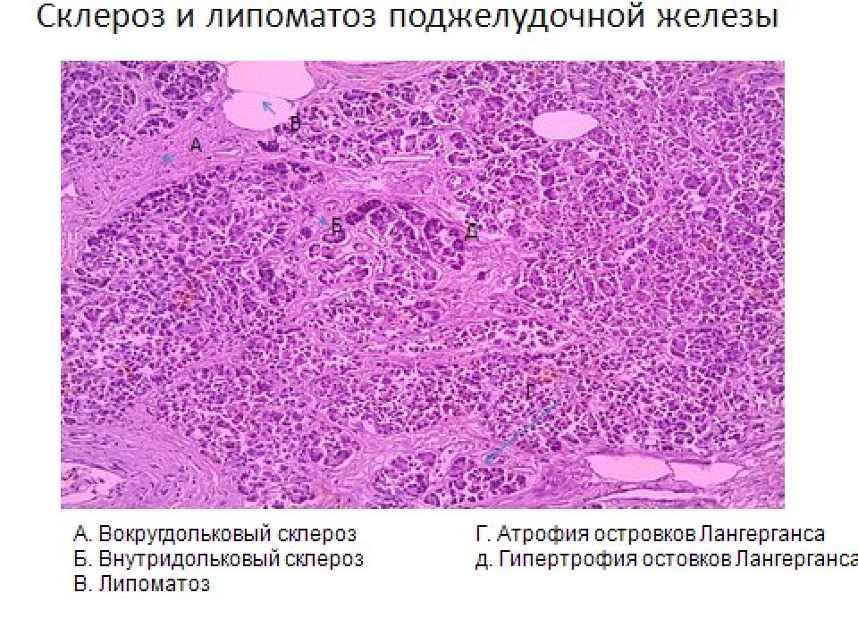 Сахарный диабет патанатомия презентация