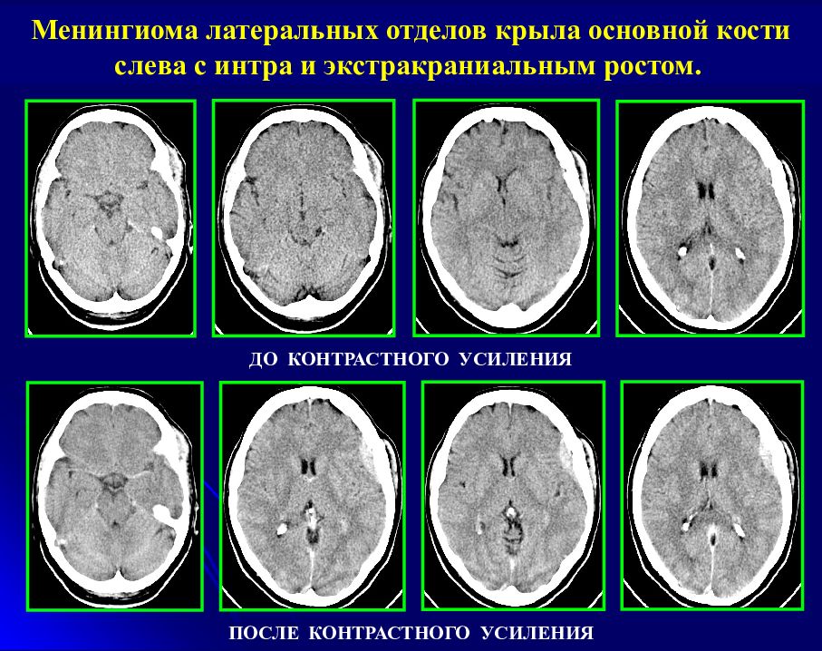 Менингиома на кт. Менингиома основной кости. Менингиома крыла основной кости. Локализация менингиом головного мозга. Менингиомы на кт.