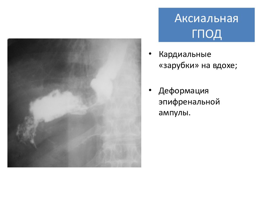 Грыжа пищеводного отверстия диафрагмы симптомы. Аксиальная кардиальная ГПОД. Аксиальная грыжа пищеводного отверстия диафрагмы. Признаки аксиальной кардиальной ГПОД.